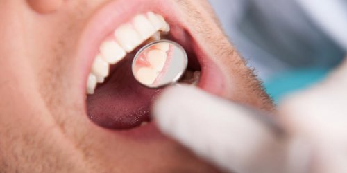 Dents : Mise en garde sur les plombages au mercure 