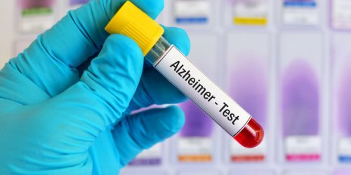 Alzheimer : ce test peut detecter la maladie 17 ans plus tot