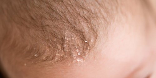 Dermatite seborrheique : comment enlever les croutes de lait de bebe ?
