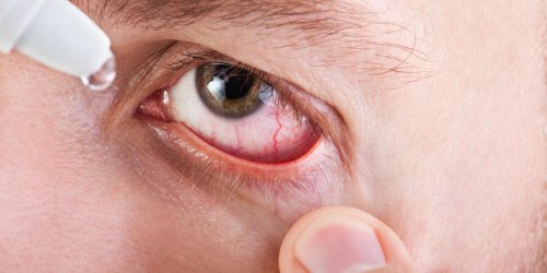 Œil irrite : une secheresse oculaire en cause