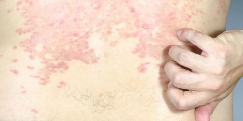 Psoriasis, eczema, dermite seborrheique et dermatite atopique : quelles differences ?