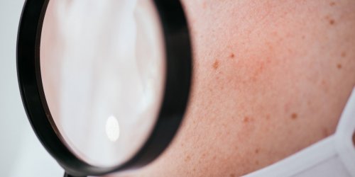 Prevention du melanome : proteger et surveiller sa peau