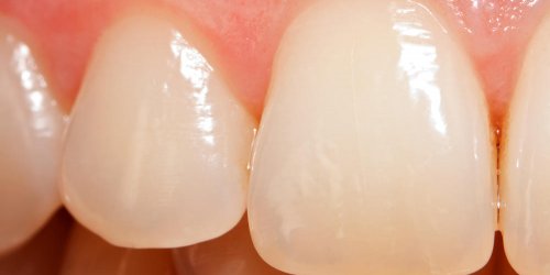Un dentifrice qui regenere l-email des dents en 3 jours