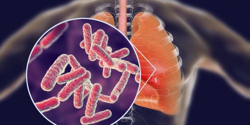 Pneumonie bacterienne : la contagion