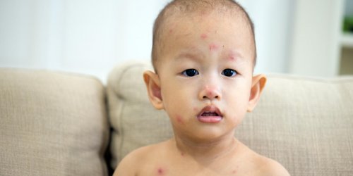 Fievre chez bebe : quand penser a la varicelle