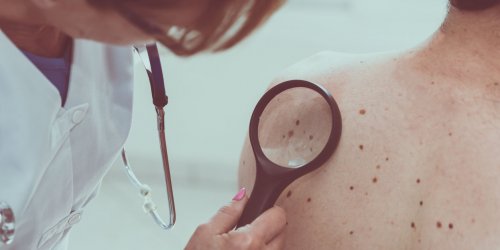 Cancer de la peau : vos selles peuvent vous soigner ! 