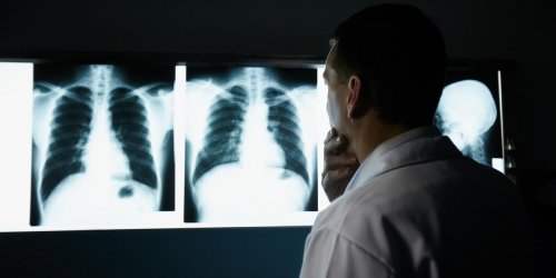 Recidive du cancer du poumon : le taux de survie