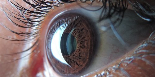 Decollement de la retine : la definition
