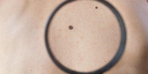 Cancer de la peau : la taille a partir de laquelle un grain de beaute doit inquieter