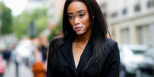 Bientot une creme pour soigner le vitiligo