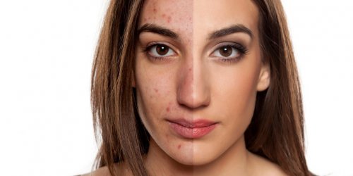 Les complements alimentaires pour stopper l-acne de la peau