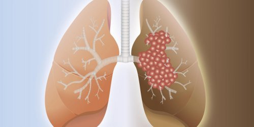 Cancer du poumon : symptomes, traitements, chance de survie, prevention 