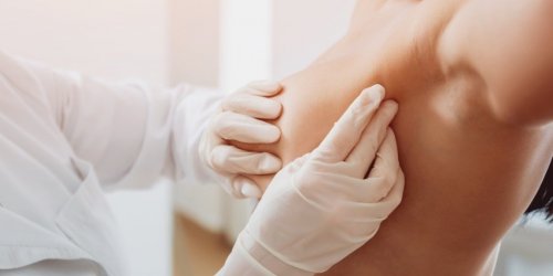Cancer du sein : comment prendre soin de ses cicatrices ?