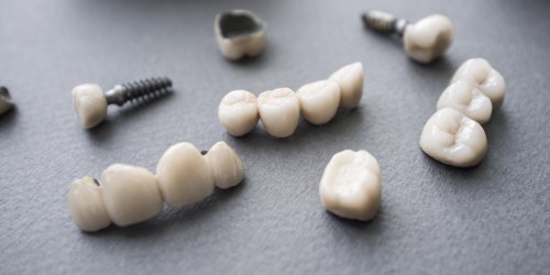 Prothese dentaire : la couronne ceramique et la couronne composite