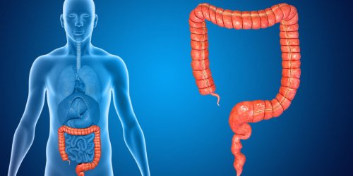 Polype au colon : ce n-est pas forcement un cancer