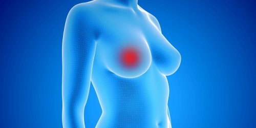 Cancer du sein : quels sont les vrais signes ?