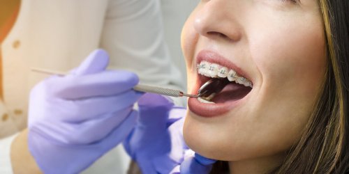 Orthodontie chez l-adulte : est-elle remboursee ?