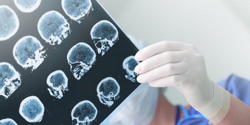Epilepsie : existe-t-il des causes psychologiques ?