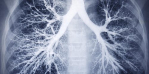 Cancer du poumon : quand un ganglion est-il dangereux ? 