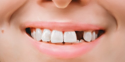  Demence : pourquoi perdre vos dents augmente les risques