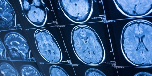 Peut-on vivre avec une tumeur benigne au cerveau ?