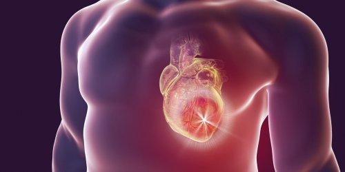 Infarctus du myocarde (crise cardiaque) : symptomes, causes, traitements 
