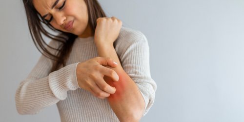 Eczema : 5 regimes a essayer pour reduire les symptomes 