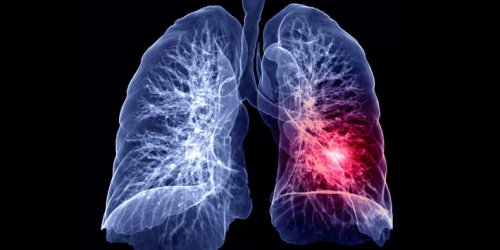 Cancer du poumon : votre risque selon la region ou vous habitez