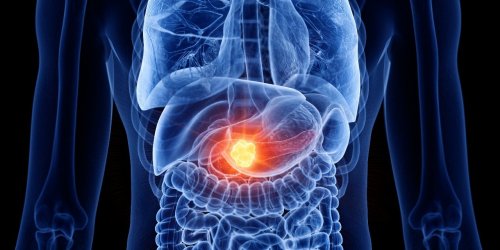 Cancer du pancreas : ces 5 sensations dans les jambes peuvent etre un signe