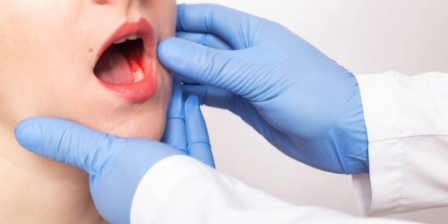 Cancer de la bouche : les 5 signes avant-coureurs a observer au quotidien