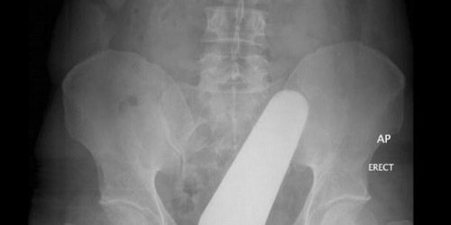 Images : Les 8 pires objets coinces dans le rectum des patients