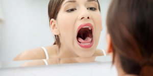 Traitement du cancer de la langue : un risque de mycose buccale