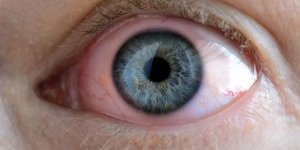 Glaucome a angle ferme : un symptome de la cataracte