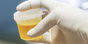 Cystite : un test urinaire pour rechercher la bacterie en cause