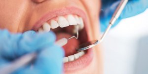 Infection dentaire : un risque d-endocardite