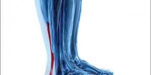 Rupture du tendon d-Achille : l-operation obligatoire ?