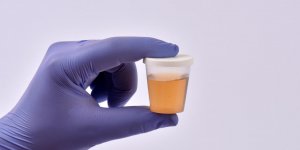 Sang dans les urines : l-examen de cytologie urinaire