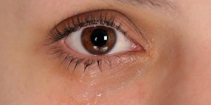 Yeux gonfles qui pleurent : blepharite ou conjonctivite ?