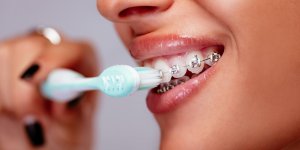 Appareil dentaire : comment bien l-entretenir