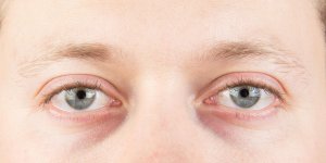 Cataracte secondaire : les symptomes caracteristiques