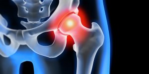 Arthrose de la hanche : reconnaitre les symptomes