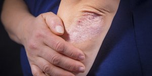 Psoriasis des coudes et genoux : quelles solutions et traitements ?