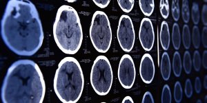 Anevrisme cerebral : le traitement par embolisation