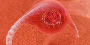 Cancer des ovaires et kyste ovarien : la difference