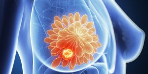 Chimiotherapie du cancer du sein : combien de temps apres l-operation ?