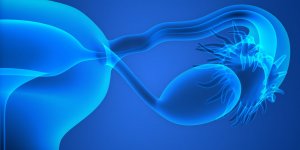 Cancer de l-ovaire : le traitement par ovariectomie
