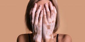 Vitiligo : comment reconnaitre les premiers signes ?