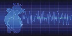 Infarctus chez la femme : le diagnostic par electrocardiogramme