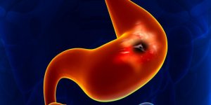Ulcere gastrique : 3 causes a connaitre