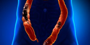 Cancer du colon : l-esperance de vie